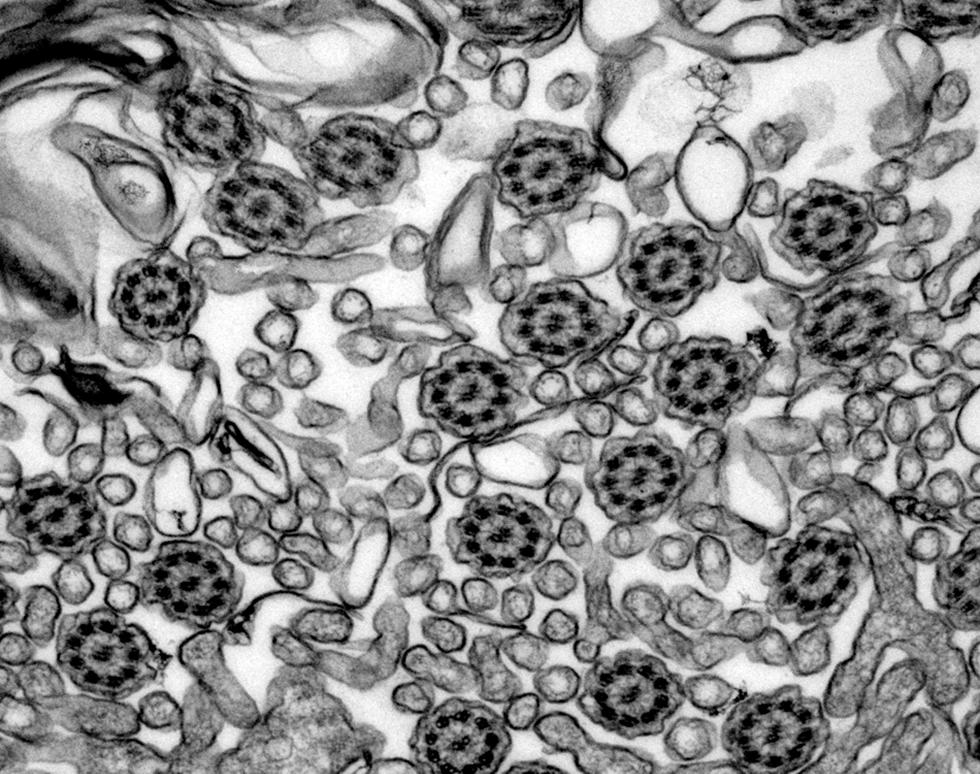 Cilia from patient with Primary Ciliary Diskynesia (PCD)